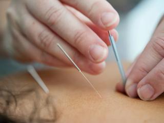 Acupuncture in Taupo