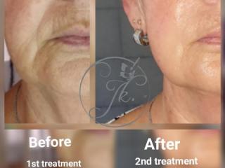 Skin Restoration 