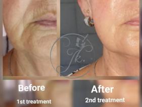 Skin Restoration 